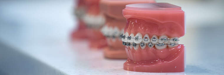 Ortodonski aparatić ne oštećuje zubnu caklinu