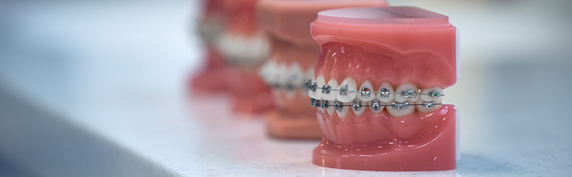 Ortodonski aparatić ne oštećuje zubnu caklinu